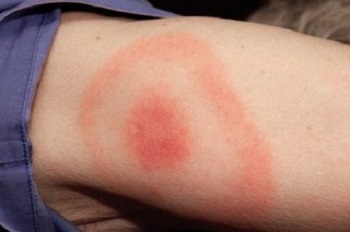 Lyme disease 350